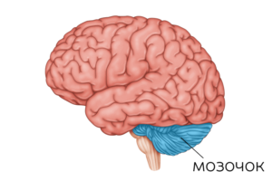 Инсульт мозжечка: какие последствия и какие пути к выздоровлению?